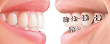 braces-vs-clear-braces